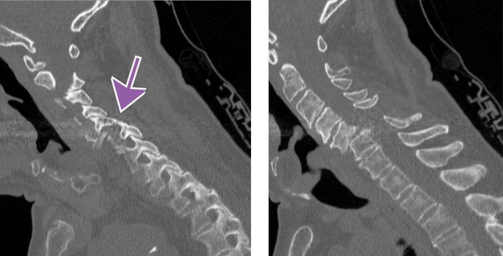 radiographic image of a spinal with malalignment of the facet joints.