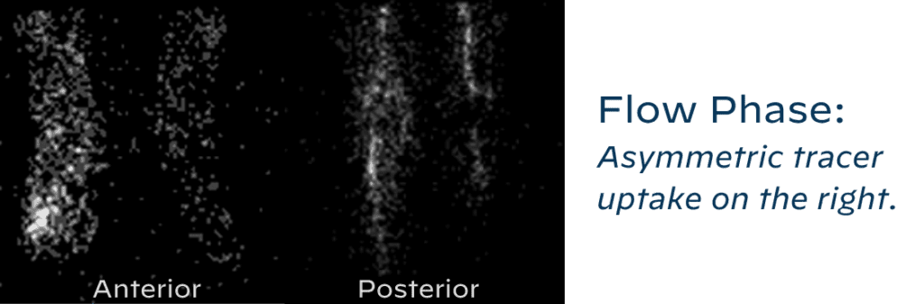 Three phase bone scan depicting flow phase