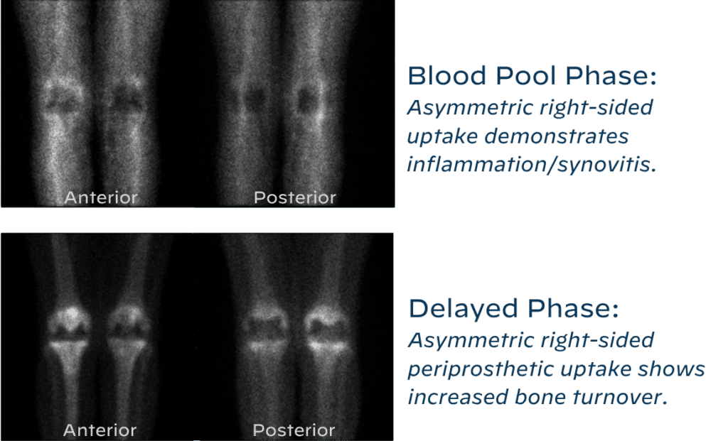 Three phase bone scan depicting bloog pool phase and delayed phase