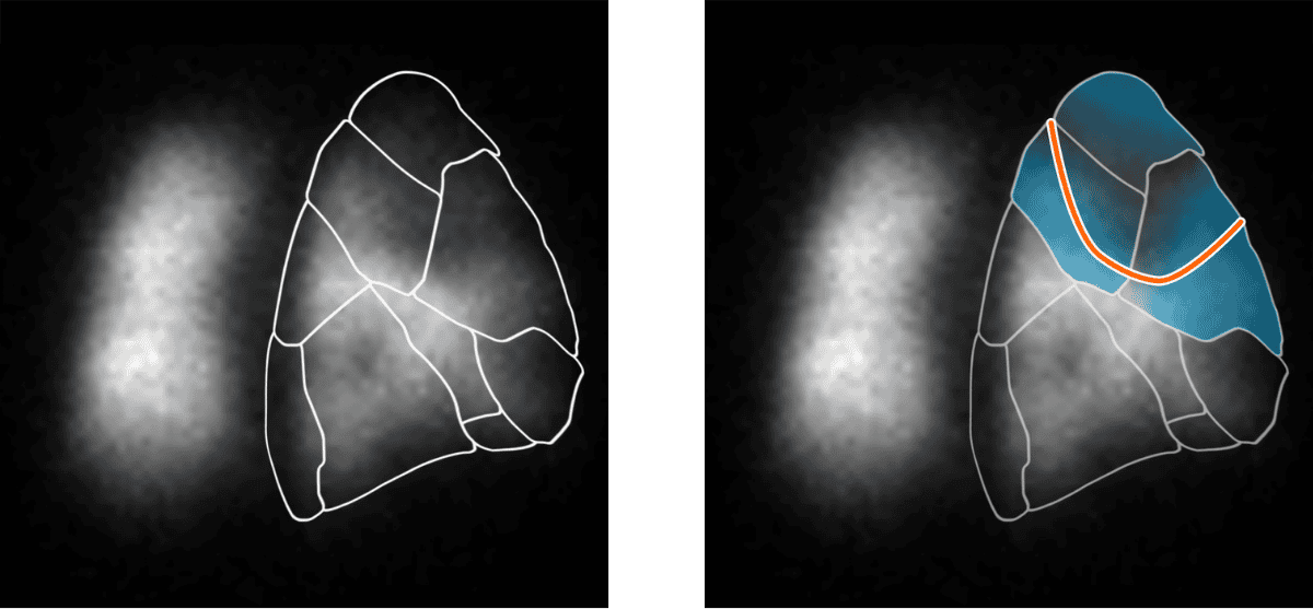 Two grayscale images of a lung scan: the left image shows lung regions outlined in white, while the right highlights the upper-right lung region in blue with an orange border, demonstrating detailed focus on that area as part of Rad to Rad Learning.
