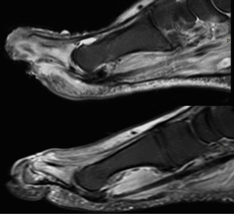 T2 edema signal.
