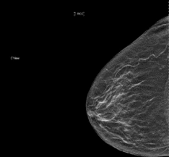 A mammogram image showing the soft tissue structure of a breast for Rad to Rad Learning.