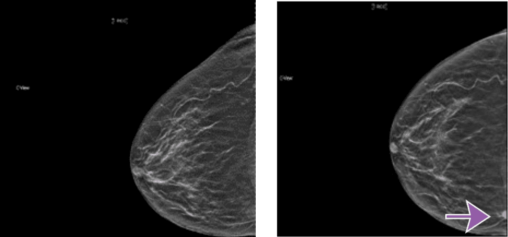Side-by-side mammogram images for Rad to Rad learning, with a purple arrow in the right image pointing to a spot in the lower breast tissue.