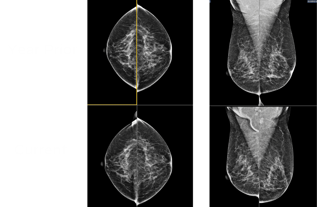 Comparison of current and prior-year screening mammograms used for Rad to Rad learning.