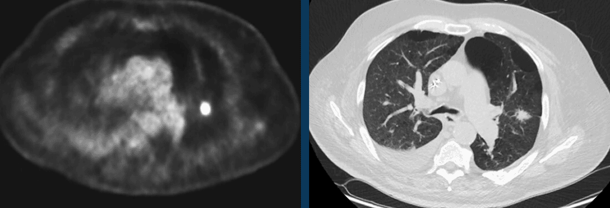 Subsolid Pulmonary Nodules on FDG PET/CT
