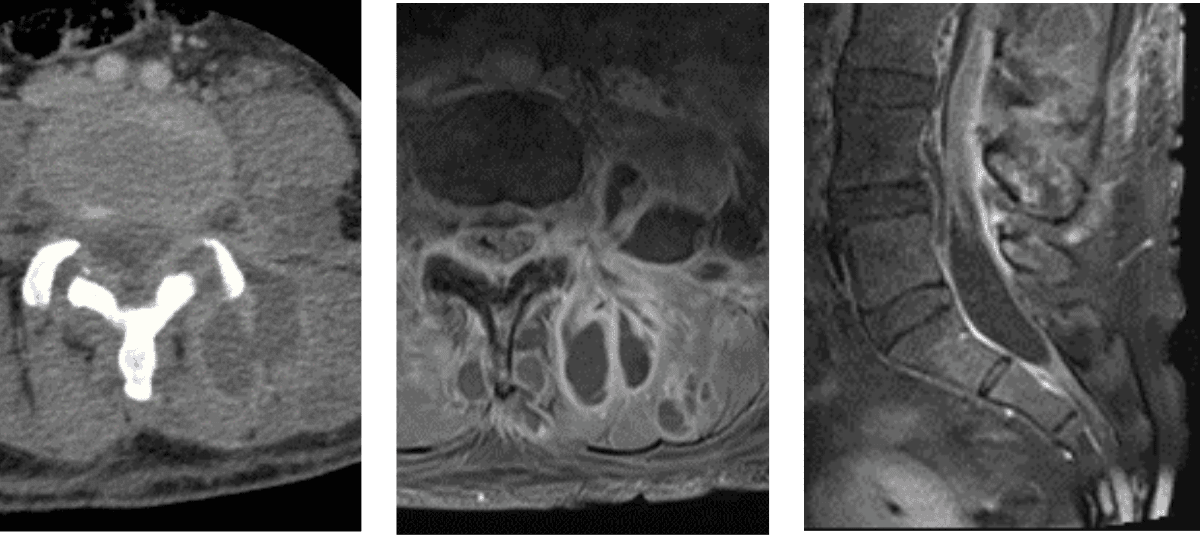 Three medical images: a CT scan (left), an axial MRI (center), and a sagittal MRI (right) of the lumbar spine, showing different views of spinal anatomy and structures—ideal for Rad to Rad Learning and comparative radiology education.