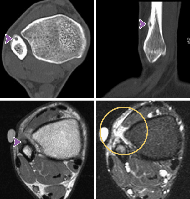 Four medical scans of a limb, ideal for Rad to Rad Learning, show a small circular lesion marked by arrows and a circle, highlighting an abnormal area near a bone, likely for diagnostic purposes.